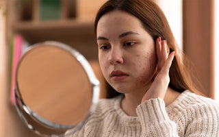 Acné Hormonal: Cómo Identificarlo y Combatirlo Efectivamente