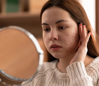 Acné Hormonal: Cómo Identificarlo y Combatirlo Efectivamente