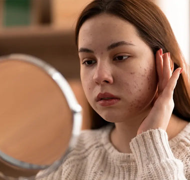 Acné Hormonal: Cómo Identificarlo y Combatirlo Efectivamente